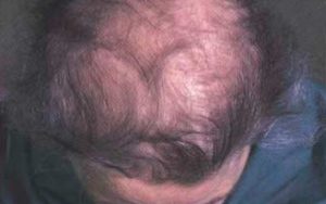 Димексид от выпадения волос