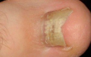Грибок ногтей на ногах - лечение димексидом